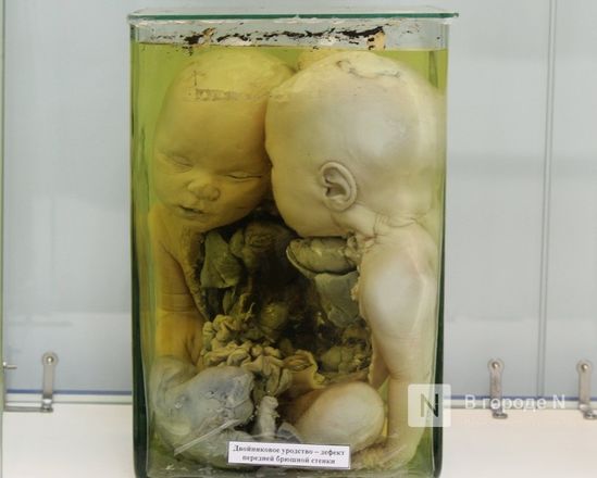 Нижегородская Кунсткамера: от сиамских близнецов до гигантских опухолей - фото 53